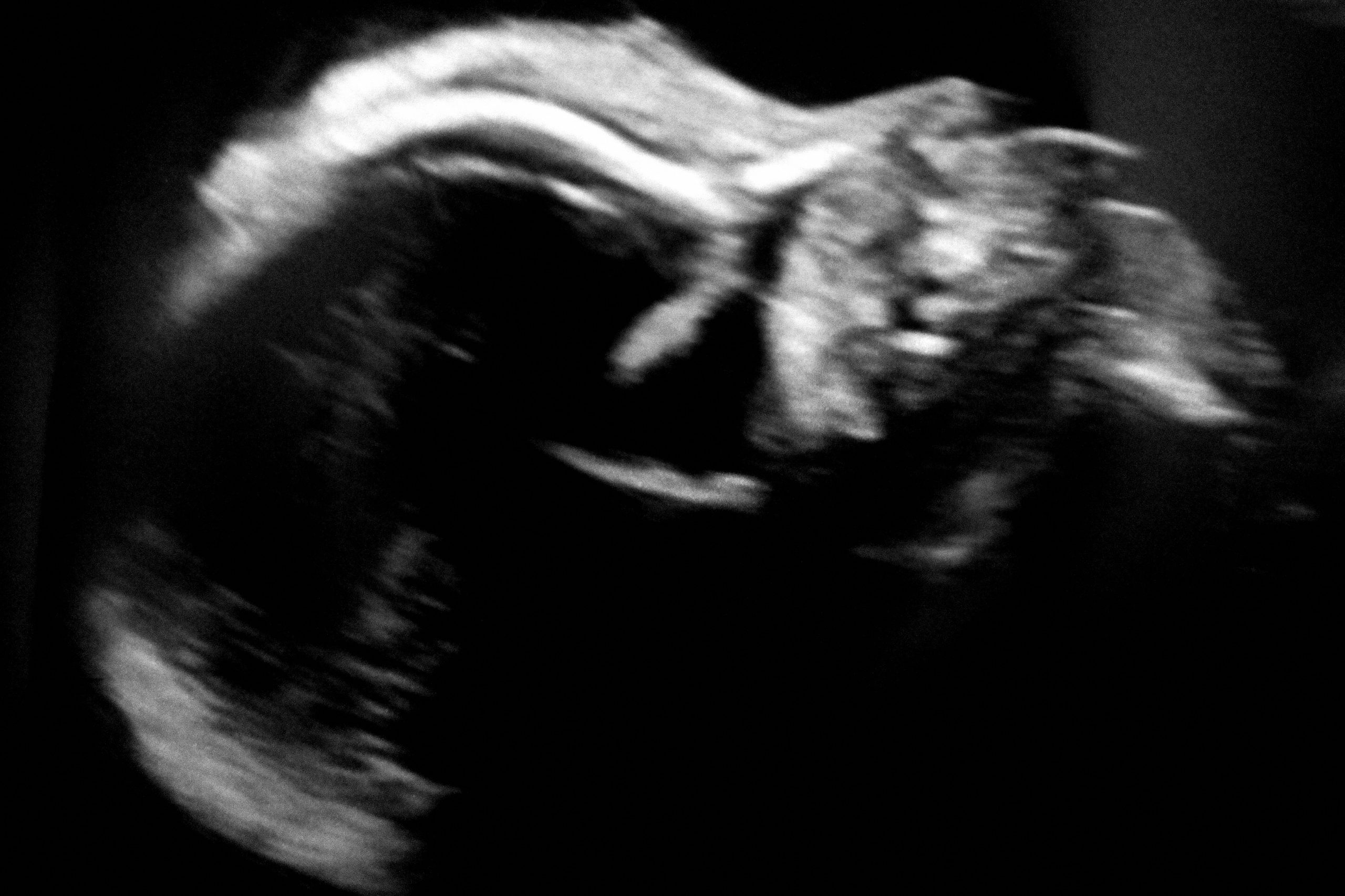 Thien anh Seneca ultrasound pregnancy